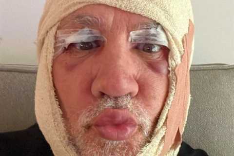 Celebs Go Dating’s Wayne Lineker reveals his two black eyes and bruised face after secret surgery