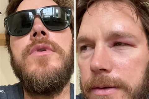 Chris Pratt Reveals Swollen Eye After Being Inspired By 'Bee Lady': 'F--k That'