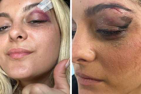 Bebe Rexha Shows Off Injuries After Being Hit with Cell Phone: 'I'm Good, Yeah, I'm Feelin' Alright'