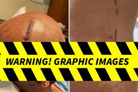 Man Stabbed In 2 Cold Scorpio Fight Needed Staples, Stitches, Horrific Pics Show