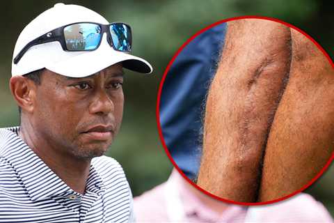 Tiger Woods Shows Off Gnarly Leg Scars Three Years After Car Crash