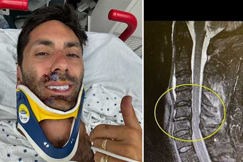 Nev Schulman Breaks Neck in Bike Accident