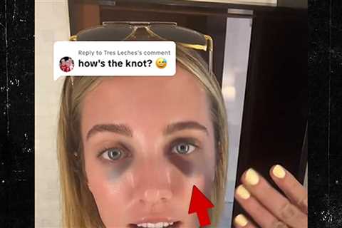 WNBA’s Lexie Hull Left W/ Two Black Eyes After Brutal Mid-Game Collision