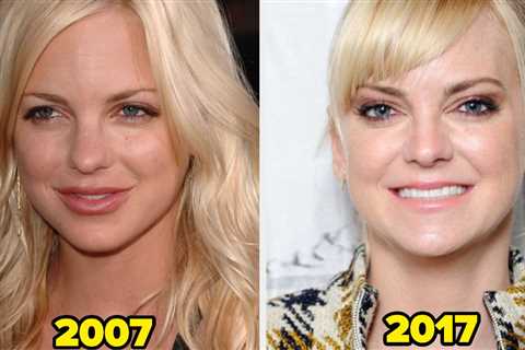 17 Celebs Who Dissolved Or Stop Getting Facial Fillers (And Why)