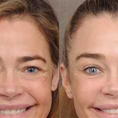 Denise Richards' Doctor Shares Photos Before and After Facelift