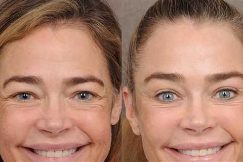 Denise Richards' Doctor Shares Photos Before and After Facelift